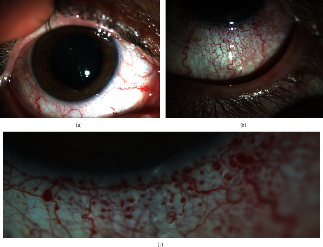 A Rare Coexistence of Isolated Unilateral Conjunctival Telangiectasia and Retinal Vascular Tortuosity.