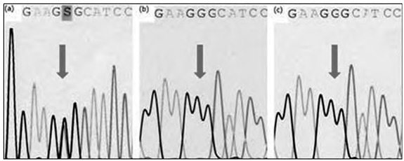 Ankyloblepharon-ectodermal Defects-cleft Lip-palate Syndrome Due to a Novel Missense Mutation in the SAM Domain of the <i>TP63</i> Gene.