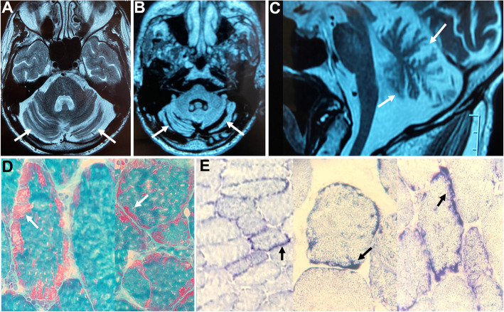 Should we investigate mitochondrial disorders in progressive adult-onset undetermined ataxias?