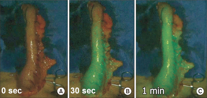 Fluorescence Image-Based Evaluation of Gastric Tube Perfusion during Esophagogastrostomy.