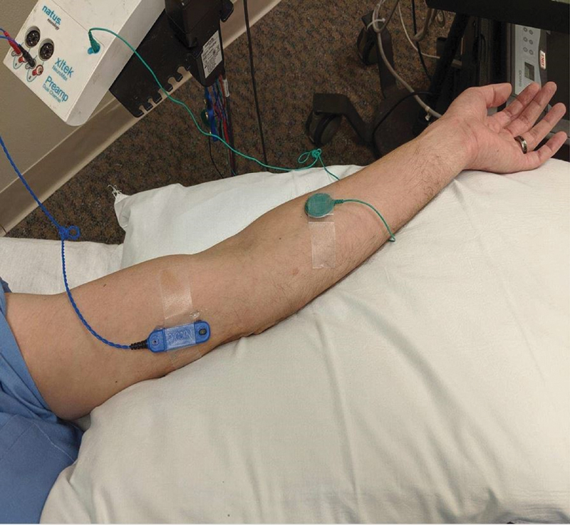 An Additional Electrodiagnostic Tool for Ulnar Neuropathy: Mixed across the Elbow.