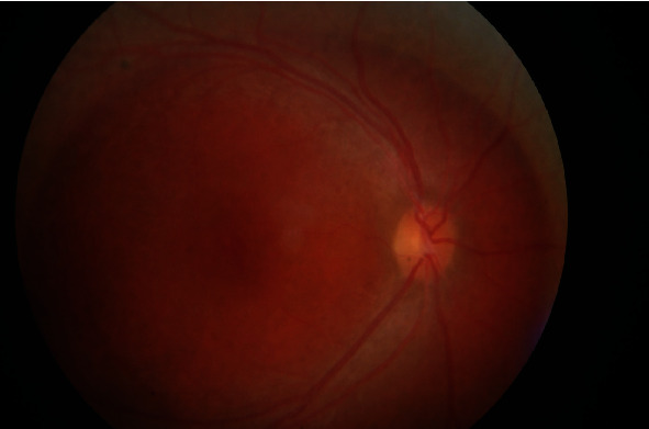 A Female Case of X-Linked Retinoschisis with Macular Hole Bilaterally.