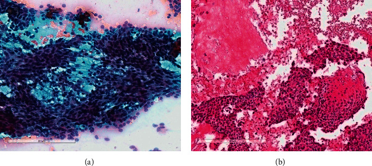 Novel Mutations in Pilomatrixoma, CTNNB1 p.s45F, and FGFR2 p.s252L: A Report of Three Cases Diagnosed by Fine-Needle Aspiration Biopsy, with Review of the Literature.