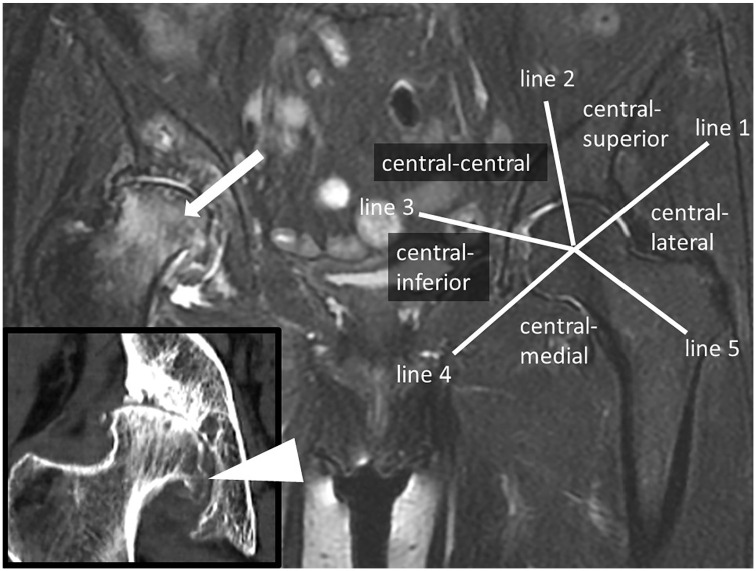 The Differences in Imaging Findings Between Painless and Painful Osteoarthritis of the Hip.