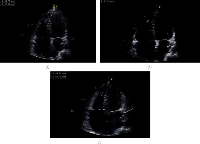 A Novel <i>EMD</i> Mutation Identified by Whole-Exome Sequencing in Twins with Emery-Dreifuss Muscular Dystrophy.