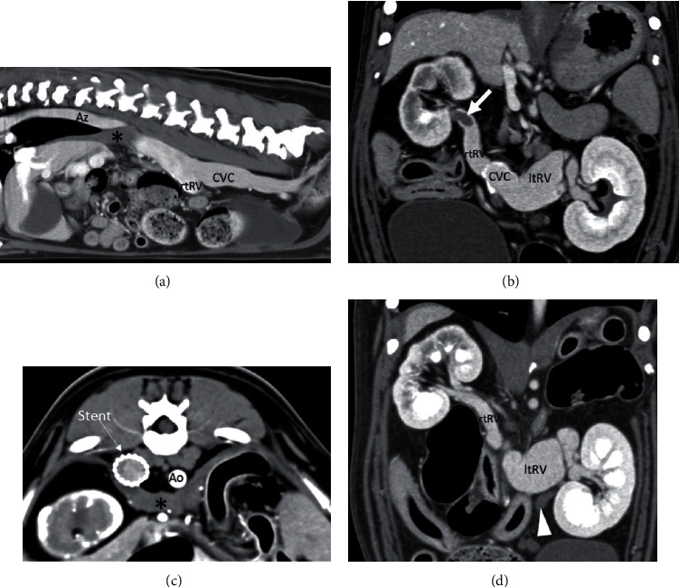 Percutaneous Cava Stenting in a Dog with Symptomatic Azygos Continuation of the Caudal Vena Cava.