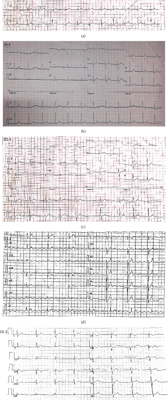 A Novel <i>EMD</i> Mutation Identified by Whole-Exome Sequencing in Twins with Emery-Dreifuss Muscular Dystrophy.