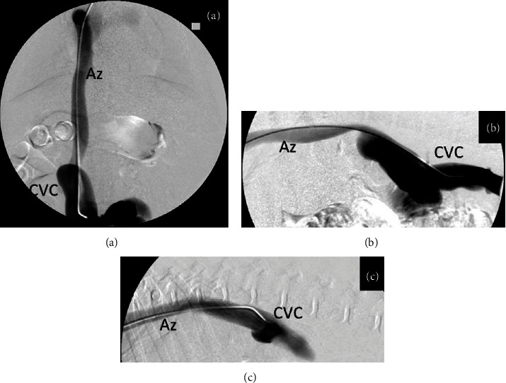 Percutaneous Cava Stenting in a Dog with Symptomatic Azygos Continuation of the Caudal Vena Cava.