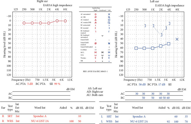 Middle Ear Salivary Choristoma: A Rare Case Report and Update on Congenital Associations, Facial Nerve Involvement, and Treatment Strategies.