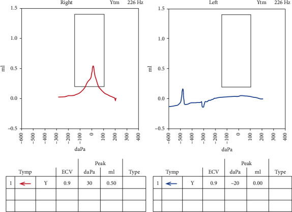 Middle Ear Salivary Choristoma: A Rare Case Report and Update on Congenital Associations, Facial Nerve Involvement, and Treatment Strategies.