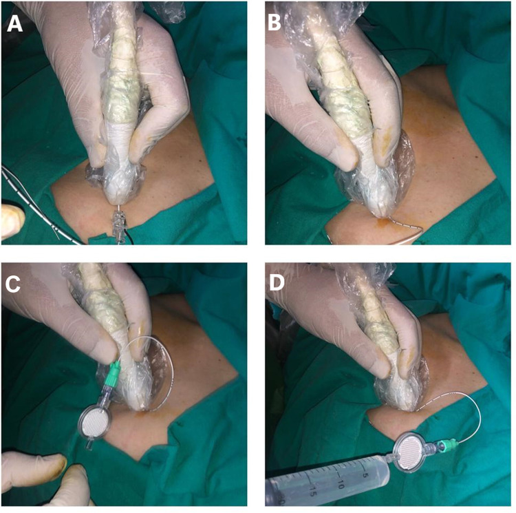 Establishing a Technique for Pectoral II-Block Catheter Insertion with Ultrasound Guidance: A Randomized Controlled Trial.