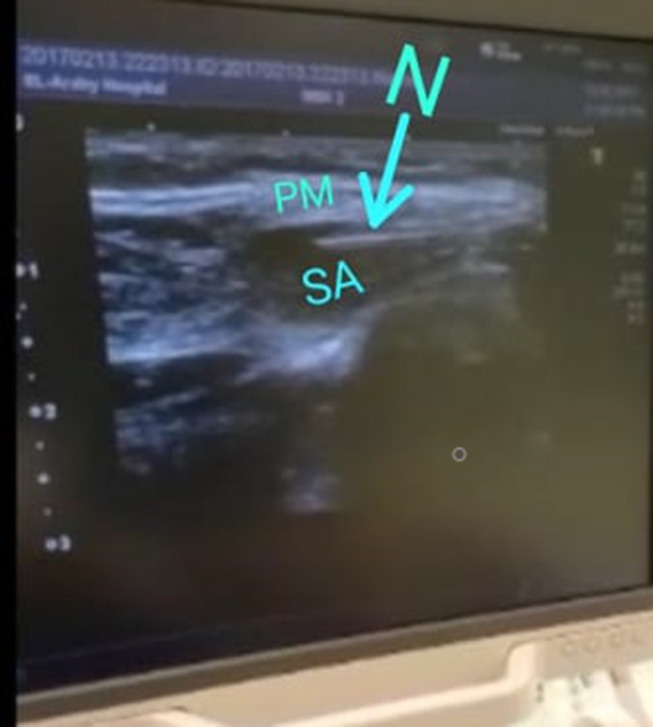 Establishing a Technique for Pectoral II-Block Catheter Insertion with Ultrasound Guidance: A Randomized Controlled Trial.