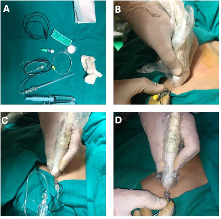 Establishing a Technique for Pectoral II-Block Catheter Insertion with Ultrasound Guidance: A Randomized Controlled Trial.