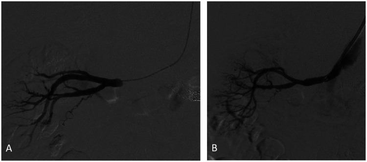Renal salvage using stent graft placement after acute renal artery occlusion with prolonged ischemic time.