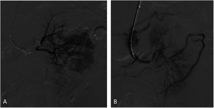 Renal salvage using stent graft placement after acute renal artery occlusion with prolonged ischemic time.