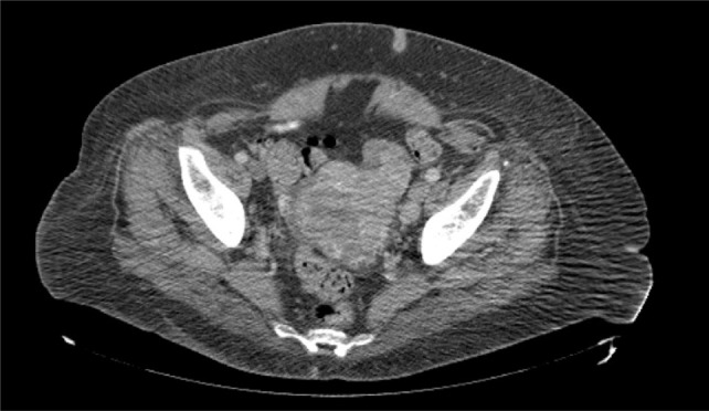 Renal Cell Carcinoma with Direct Extension into the Gonadal Vein, Uterus, Fallopian Tube, and Bilateral Ovaries: A Case Report.