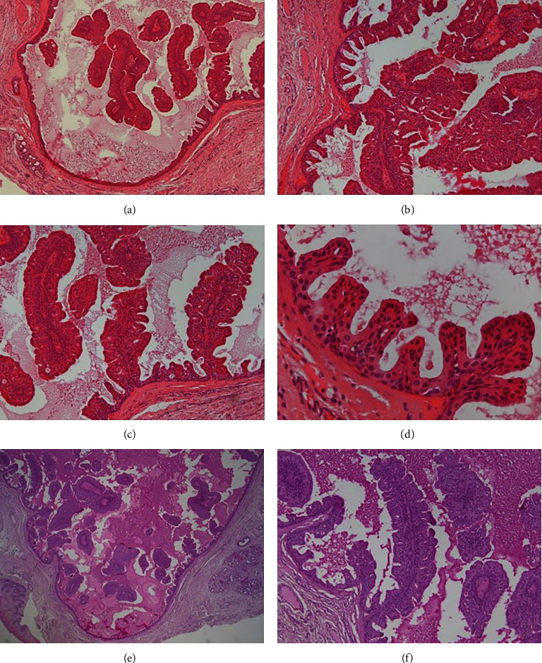 A Rare Case of Intraductal Papilloma Arising from Minor Salivary Gland in the Floor of the Mouth.