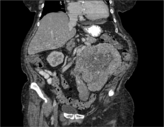 Renal Cell Carcinoma with Direct Extension into the Gonadal Vein, Uterus, Fallopian Tube, and Bilateral Ovaries: A Case Report.