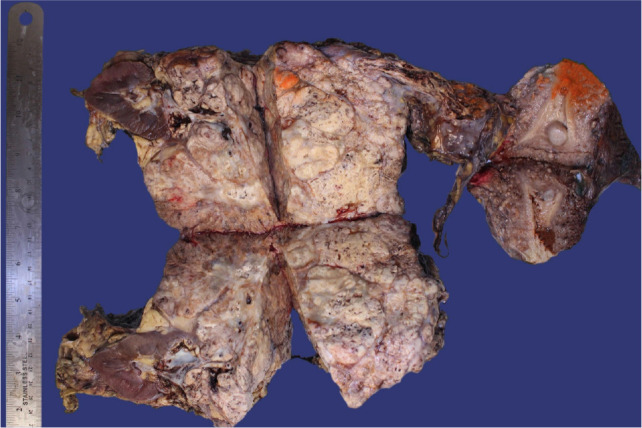 Renal Cell Carcinoma with Direct Extension into the Gonadal Vein, Uterus, Fallopian Tube, and Bilateral Ovaries: A Case Report.