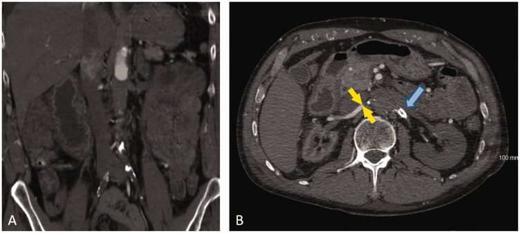 Renal salvage using stent graft placement after acute renal artery occlusion with prolonged ischemic time.