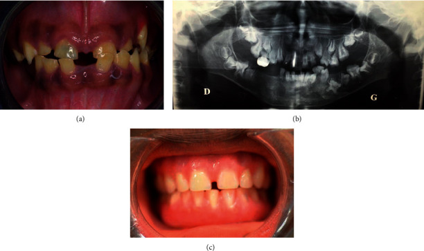 "Isolated" Amelogenesis Imperfecta Associated with <i>DLX3</i> Mutation: A Clinical Case.