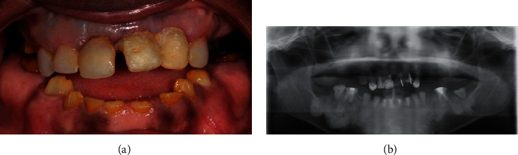 "Isolated" Amelogenesis Imperfecta Associated with <i>DLX3</i> Mutation: A Clinical Case.