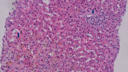 Rifampicin for Treatment of Cholestatic Pruritus Caused by Drug-Induced Acute Liver Injury as Assessed by the RUCAM Classification.