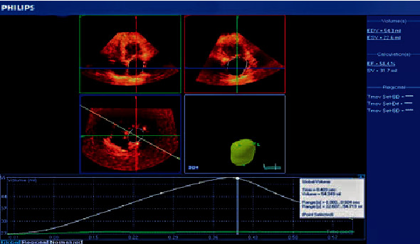 Three-Dimensional Echocardiography in Evaluating LA Volumes and Functions in Diabetic Normotensive Patients without Symptomatic Cardiovascular Disease.