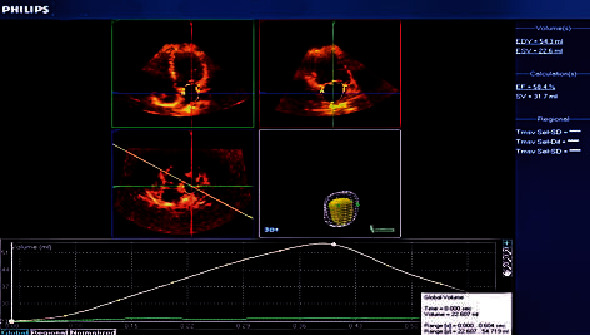 Three-Dimensional Echocardiography in Evaluating LA Volumes and Functions in Diabetic Normotensive Patients without Symptomatic Cardiovascular Disease.