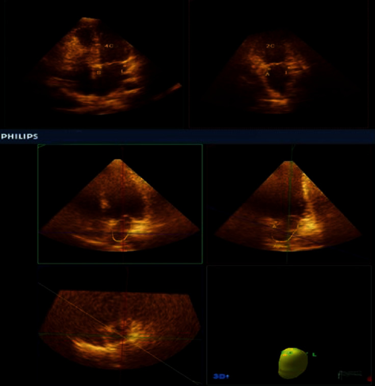 Three-Dimensional Echocardiography in Evaluating LA Volumes and Functions in Diabetic Normotensive Patients without Symptomatic Cardiovascular Disease.