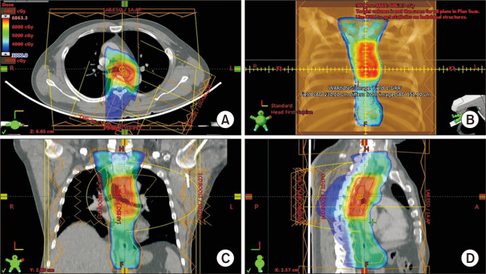 The Role of Modern Radiotherapy Technology in the Treatment of Esophageal Cancer.