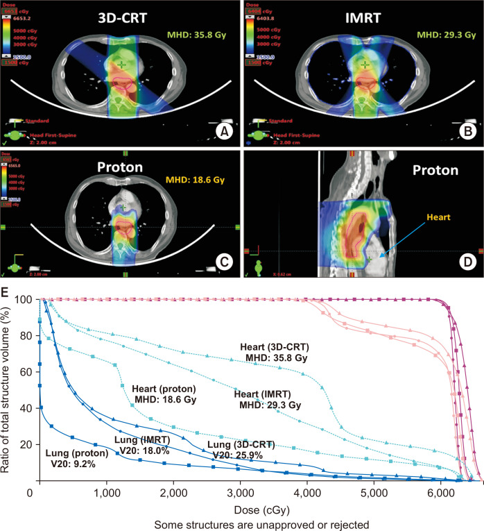 The Role of Modern Radiotherapy Technology in the Treatment of Esophageal Cancer.