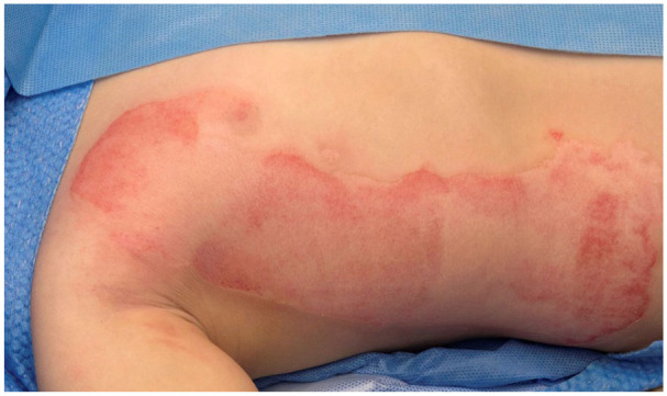 Evaluation of EpiProtect® microbial cellulose burns dressings in young children.