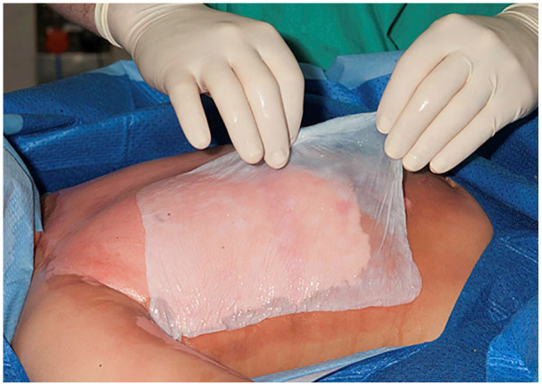 Evaluation of EpiProtect® microbial cellulose burns dressings in young children.