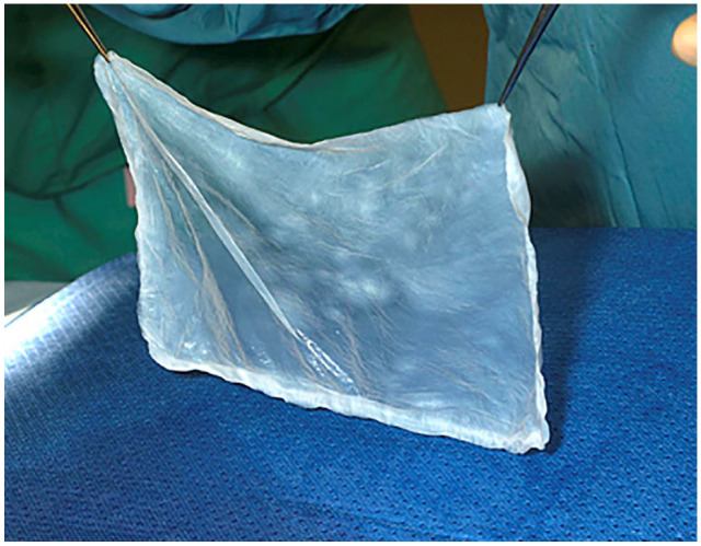 Evaluation of EpiProtect® microbial cellulose burns dressings in young children.