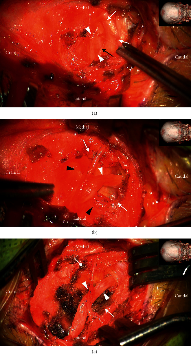 Referred Trigeminal Facial Pain from Occipital Neuralgia Occurring Much Earlier than Occipital Neuralgia.