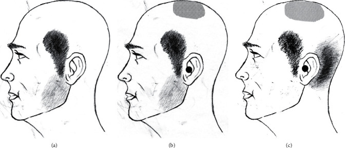 Referred Trigeminal Facial Pain from Occipital Neuralgia Occurring Much Earlier than Occipital Neuralgia.