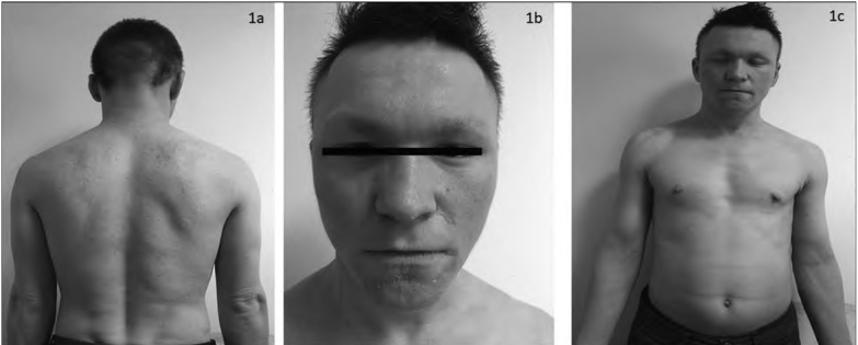 A New Splice-site Mutation of <i>SPINK5</i> Gene in the Netherton Syndrome with Different Clinical Features: A Case Report.