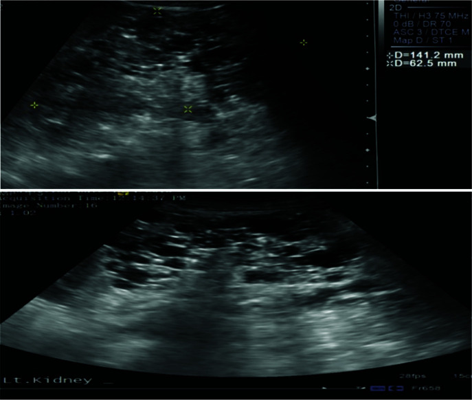 Renal Manifestations of Tuberous Sclerosis Complex.