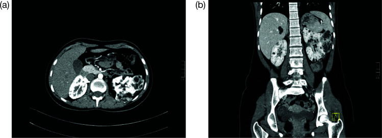 Renal Manifestations of Tuberous Sclerosis Complex.