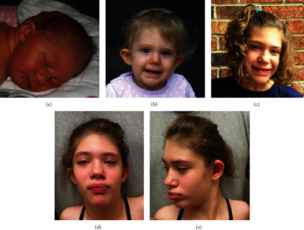 An Adolescent with a Rare <i>De Novo</i> Distal Trisomy 6p and Distal Monosomy 6q Chromosomal Combination.