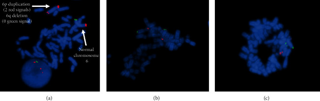 An Adolescent with a Rare <i>De Novo</i> Distal Trisomy 6p and Distal Monosomy 6q Chromosomal Combination.