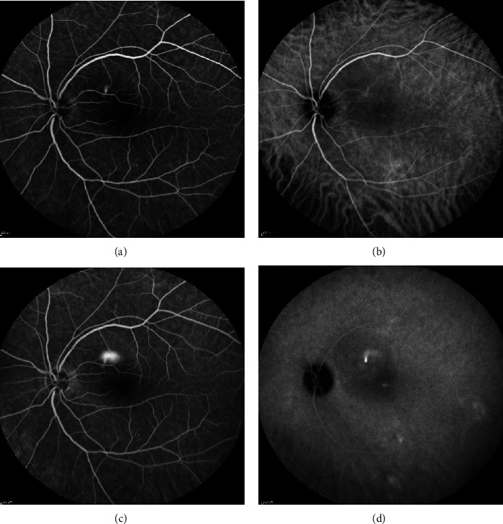 Central Serous Chorioretinopathy: Multimodal Imaging and Management Options.