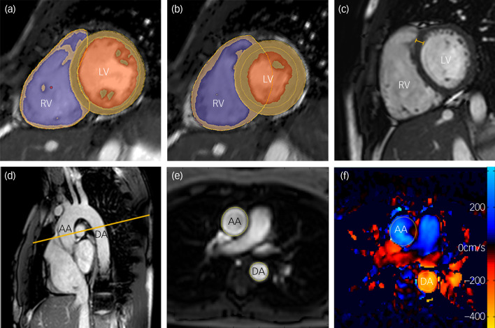 Cardiac structure and function in schizophrenia: cardiac magnetic resonance imaging study.