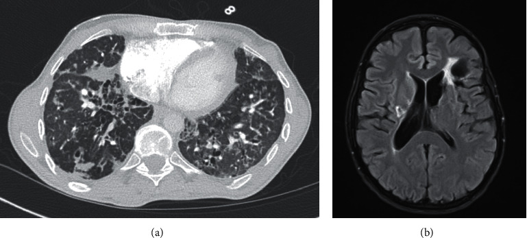 The Natural History of X-Linked Lymphoproliferative Disease (XLP1): Lessons from a Long-Term Survivor.