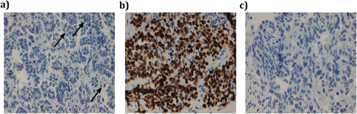 Insight updating of the molecular hallmarks in ovarian carcinoma