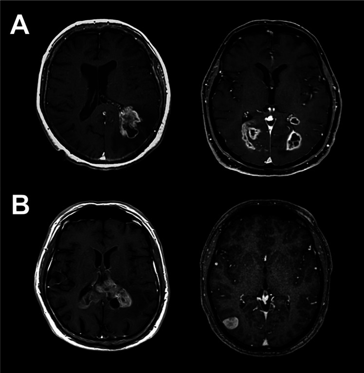 The influence of subventricular zone involvement in extent of resection and tumor growth pattern of glioblastoma.