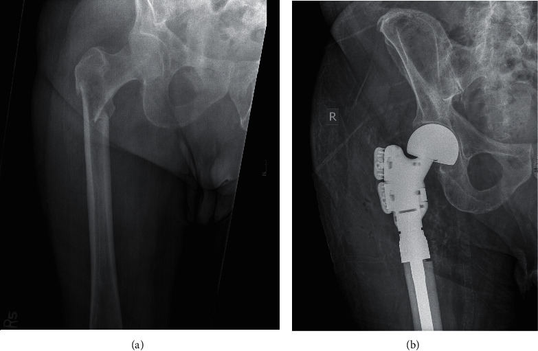 Predicting Pathologic Bone Lesions Using Scout Computed Tomography (CT) Imaging.