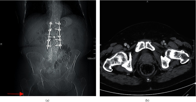 Predicting Pathologic Bone Lesions Using Scout Computed Tomography (CT) Imaging.
