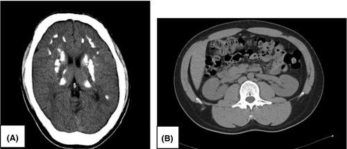 A case of hypoparathyroidism, deafness, and renal dysplasia (HDR) syndrome with a novel frameshift variant in GATA3, p.W10Cfs40, lacks kidney malformation